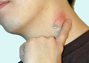 A la persona la ausencia de las muelas pequeñas y la presencia de las pecas